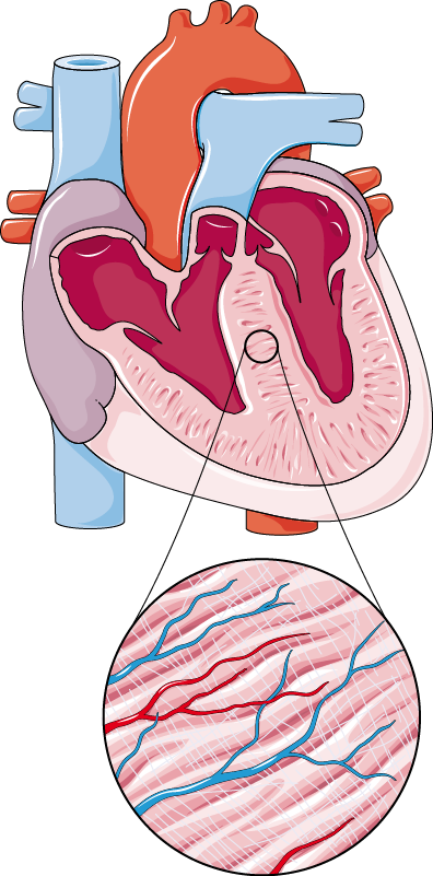 Myocardial Hypertrophy