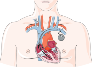 Diagnosis & Treatment of Heart Failure