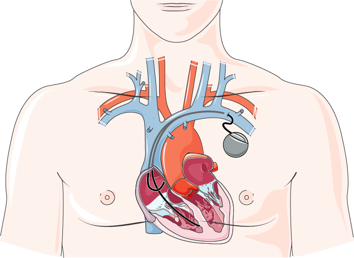 Diagnosis & Treatment of Heart Failure